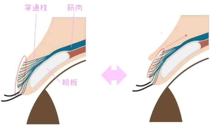 まぶた　二重になる仕組み　図解　イラスト